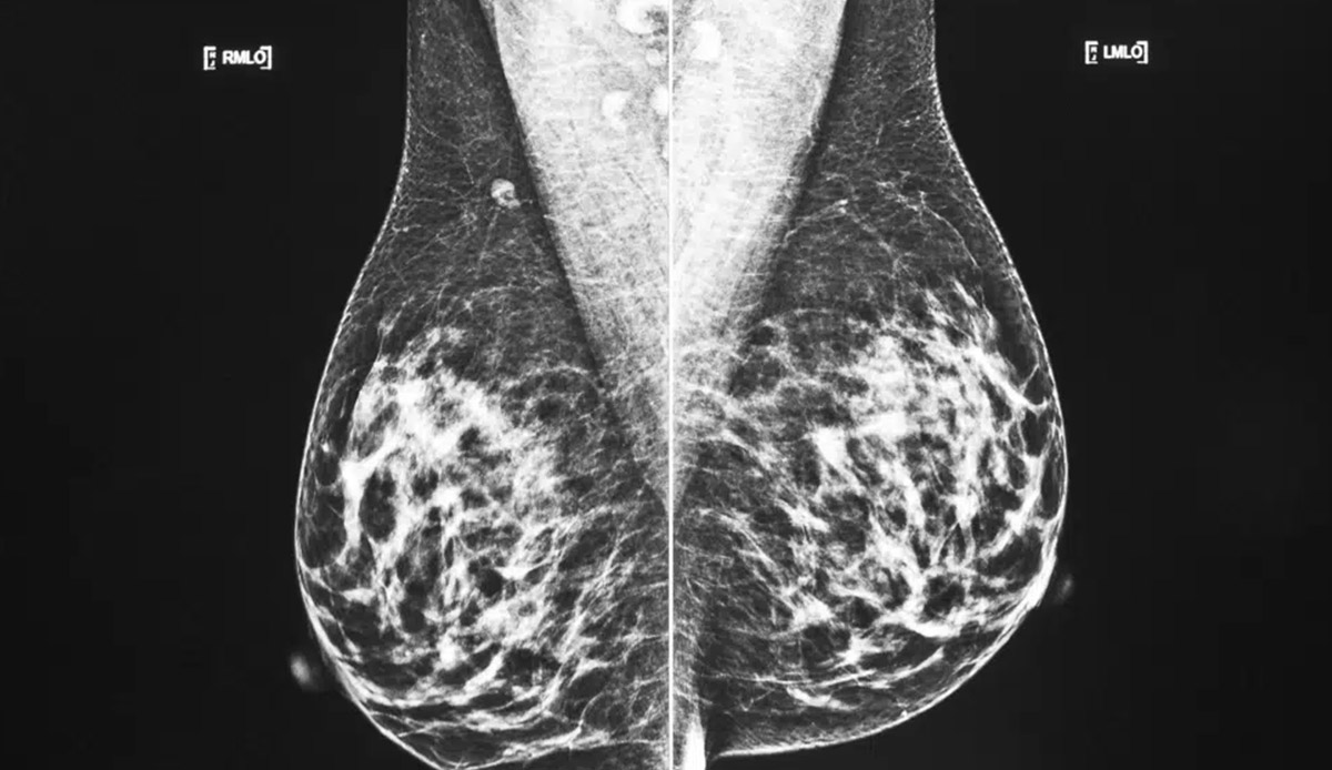 More breast cancer patients can choose smaller surgery